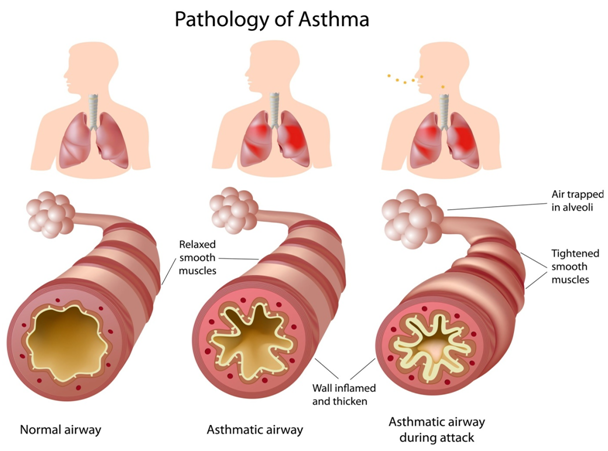 Asthma allergy doctor in Hinjewadi